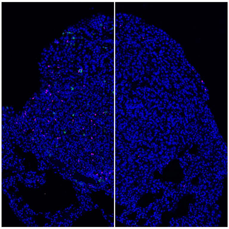 side by side of cells in two tumor sections