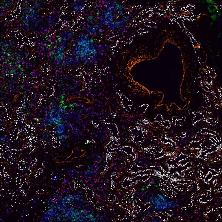 magenta, blue, yellow, and green immune cells mix with orange lung cells and white cancer cells