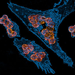 blue macrophages with orange cancer cells