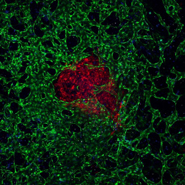 blood vessels and immune cells around a tumor