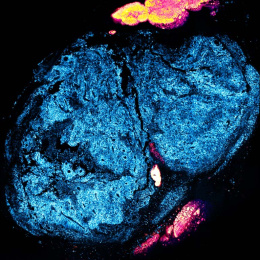 fluorescent blue molecules shine in a tumor