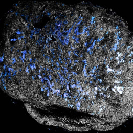 blue molecules in a grey tumor