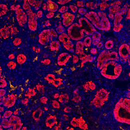 rosy red rings of intestinal cancer cells interspersed with blue cells on a black background